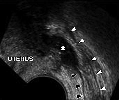 Endometriosis of the Posterior Cul-De-Sac: Clinical Presentation and ...