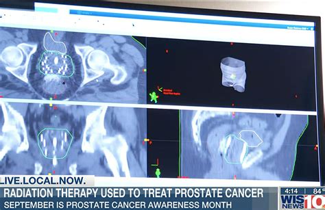 Brachytherapy External Beam Radiation Prostate Cancer - The Best Picture Of Beam