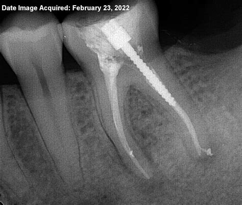 Root Canal Infection Xray