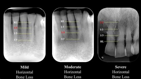 Radiographic diagnosis of periodontal diseases – Current evidence versus innovations - Jacobs ...