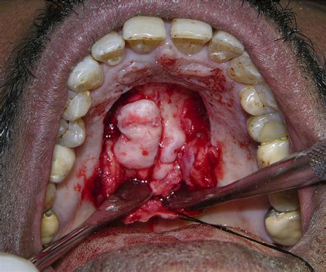 Modified Palatal Flap—A Simpler Approach for Removal of Palatal Tori - Journal of Oral and ...