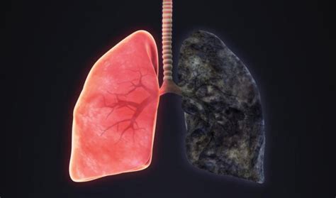 Image result for Emphysema Example