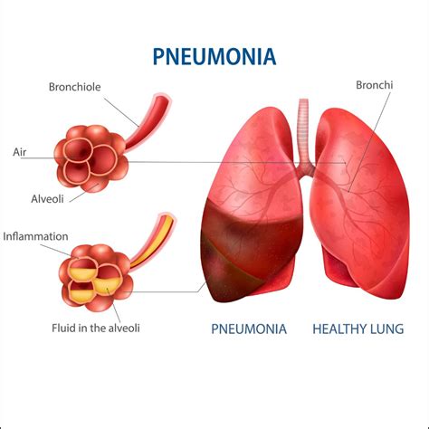 Common Symptoms of Pneumonia: How Can I Prevent It?