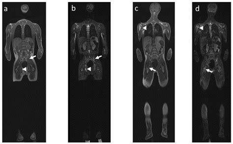 Chronic Recurrent Multifocal Osteomyelitis (CRMO) and Juvenile Spondyloarthritis (JSpA): To What ...