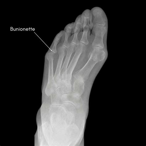 Bunionette