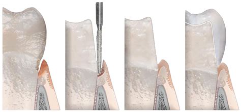 Vertical Edgeless Preparation: Periodontal Dominance in Prosthetic ...