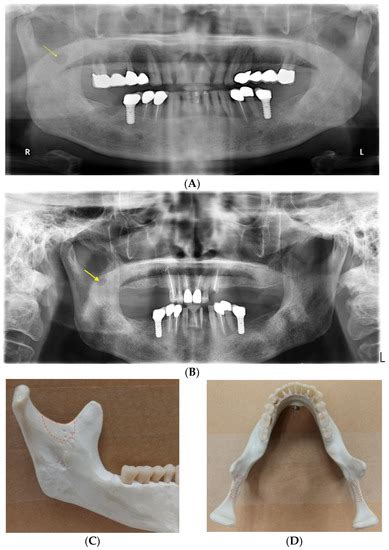 Medial Sigmoid Depression of the Mandibular Ramus as a Lesion-Mimicking ...