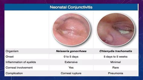 Ophthalmia Neonatorum/ Neonatal Conjunctivitis | PPTX