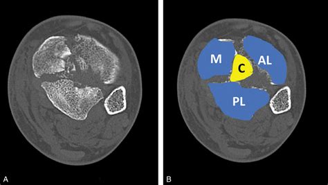 Pilon Fractures - Clinical Tree