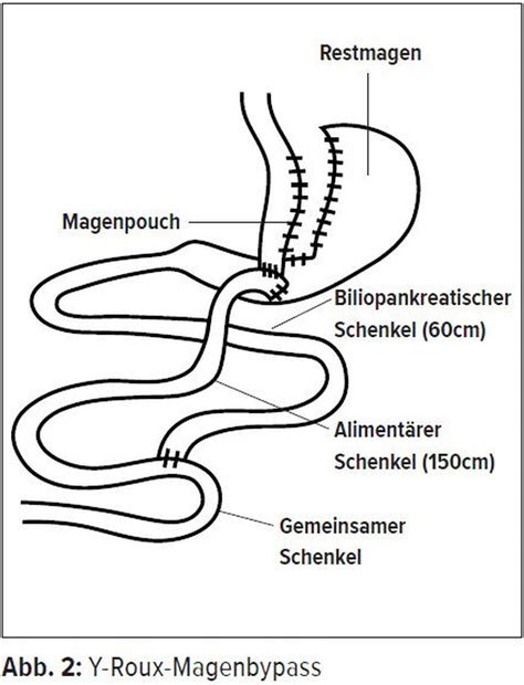Adipositaschirurgie spart Geld und verlängert Leben - Endokrinologie ...