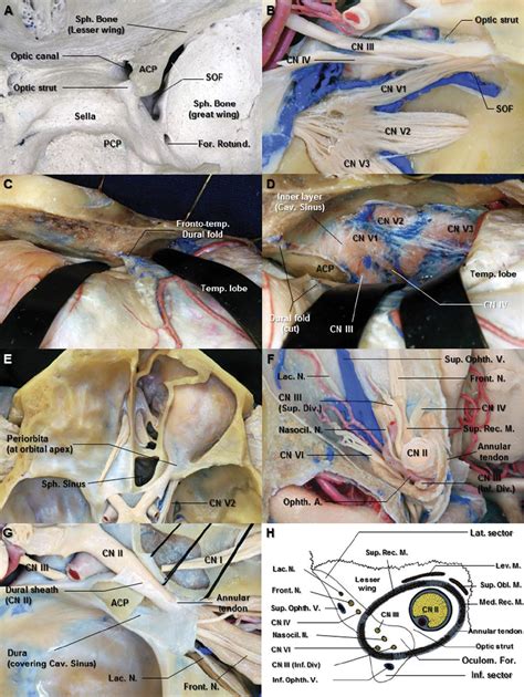 Regional Aantomy of the Orbit and Superior Orbital Fissure ...