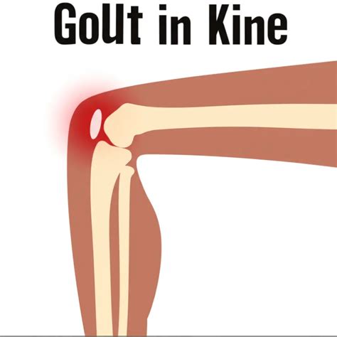 Gout In Knee: Spotting A Flare In Photos & Symptoms – Relivehealth