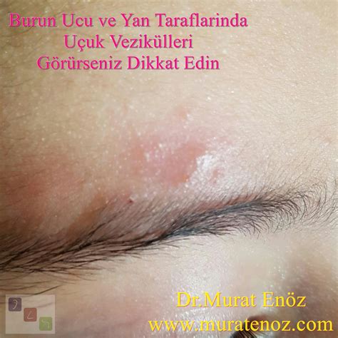 Ophthalmic Herpes Virus Infection and Hutchinson Sign