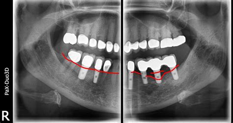 Losing Bone on My Dental Implant -Too Much Cement? | Ramsey A. Amin, DDS