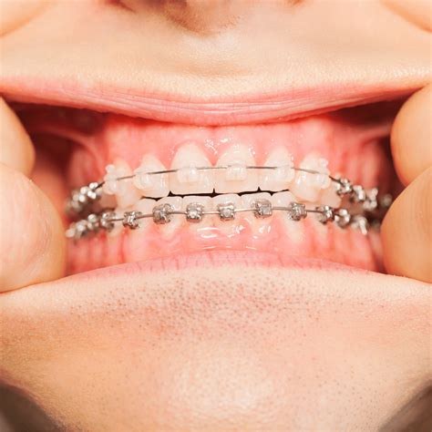 Difference Between Clear and Metal Braces: Orthodontics Explained