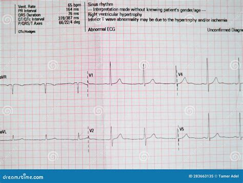 ECG ElectroCardioGraph Paper That Shows Normal Sinus Rhythm NSR With ...