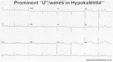 Hypokalemia Ecg