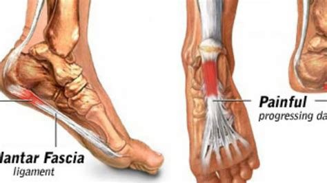 Plantar Fasciitis 的图像结果