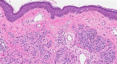 Melanocytic Nevus Histology