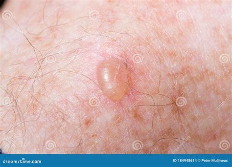 Raised Blister from Cryotherapy Stock Photo - Image of damage, keratosis: 184948614