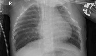 ZhangLabData: Chest X-Ray - Dataset Ninja