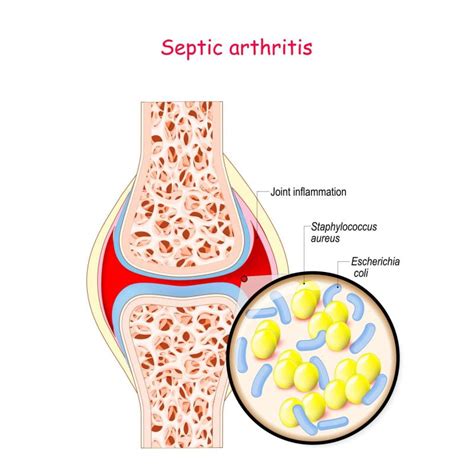 Bone and Joint Infections (Septic Arthritis / Osteomyelitis) in ...