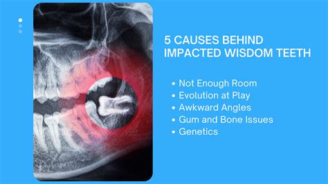 Impacted Wisdom Teeth: Symptoms and Treatment Options