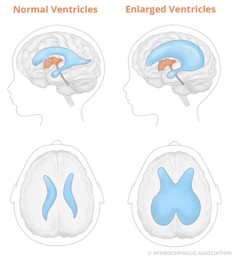 Hydrocephalus in Infants and Children: Diagnosis & Treatment