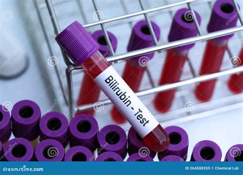 Bilirubin Test To Look for Abnormalities from Blood Stock Image - Image of health, clinic: 264508359