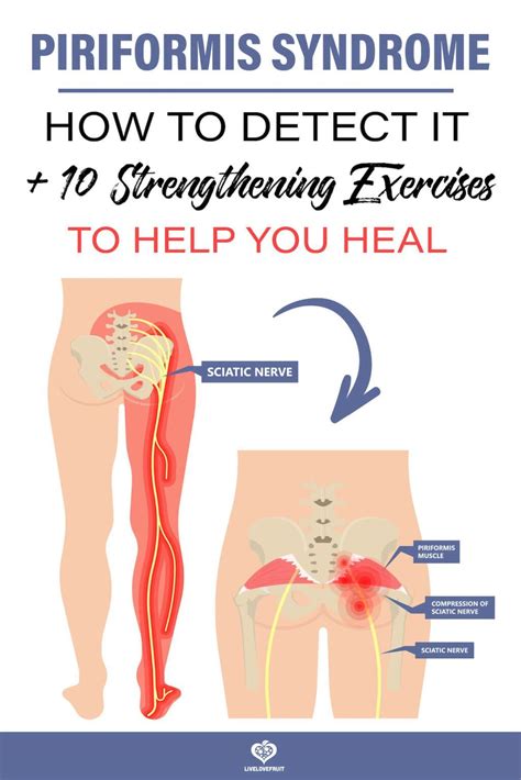 Piriformis Syndrome: How To Detect It, Plus 10 Strengthening Exercises To Help You Heal ...