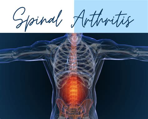 Spinal Arthritis - Spine and Wellness Centers of America
