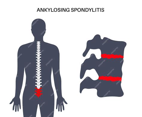 Spondylitis ankylopoetica Artritis die ontstekingen veroorzaakt in de ...