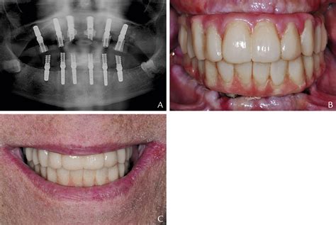 Maxillary and mandibular immediately loaded implant-supported interim complete fixed dental ...