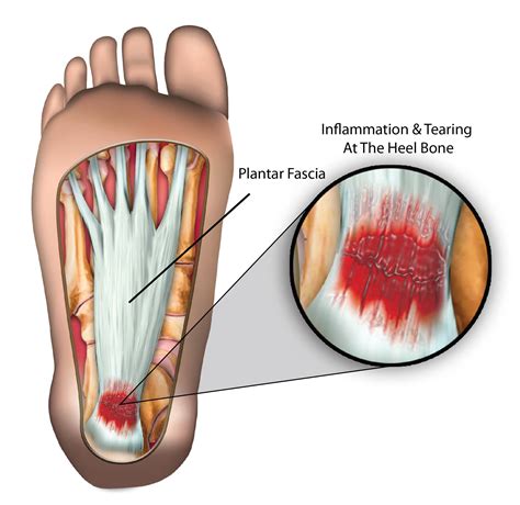 Plantar Fascia Tear