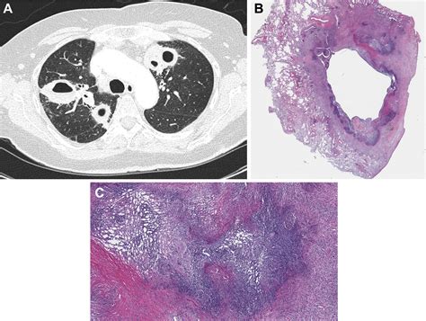 Cavitary Lung Diseases - CHEST
