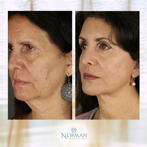 Plastic Surgery Face Lift How Long Is Deep Plane Facelift Recovery