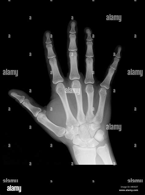 Normal X Ray The Hand Stockfotos & Normal X Ray The Hand Bilder - Alamy