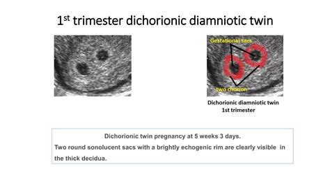 Anatomy of Monochorionic diamniotic twin | PPTX