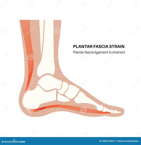 Plantar fascia strain stock vector. Illustration of tenderness - 288675449