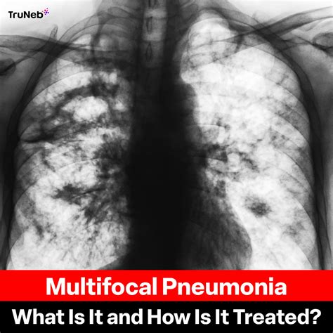 Multifocal Pneumonia: What Is It and How Is It Treated?