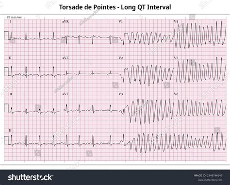 Torsades De Pointes Ecg