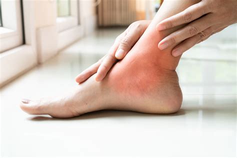 Gout - Help What Hurts