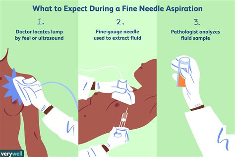 Fine Needle Aspiration for Breast Biopsy: Procedure, Side Effects