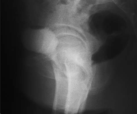 Urethral Diverticulum: Diagnosis with Virtual CT Urethroscopy | AJR