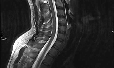MRI myelography, a feasible alternative to CT for detecting CSF leaks ...
