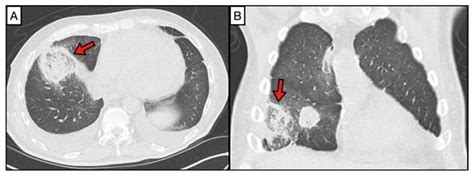 Recent Advances in Diagnostic Approaches for Mucormycosis