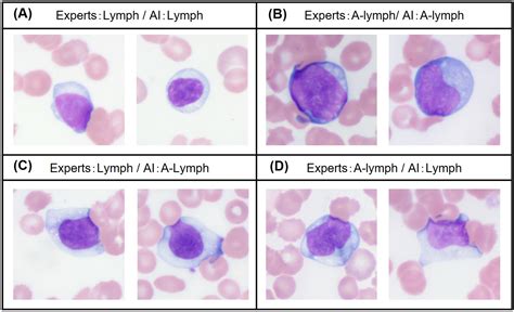 Atypical Lymphocyte