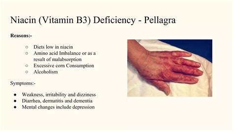Malnutrition and its prevention.pptx