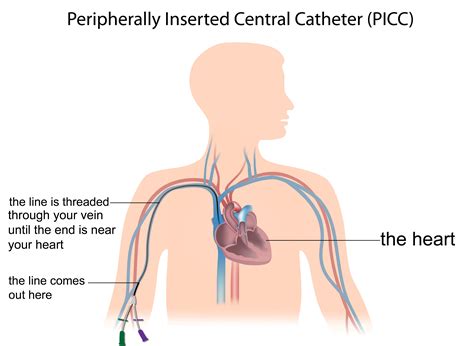 Care of your peripherally inserted central catheter :: University Hospitals of Morecambe Bay NHS ...