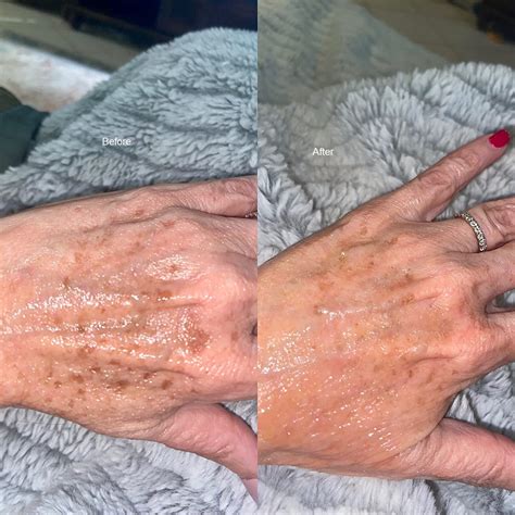 Buy Admire My Skin Dark Spot Corrector Remover for Face - Brightening ...